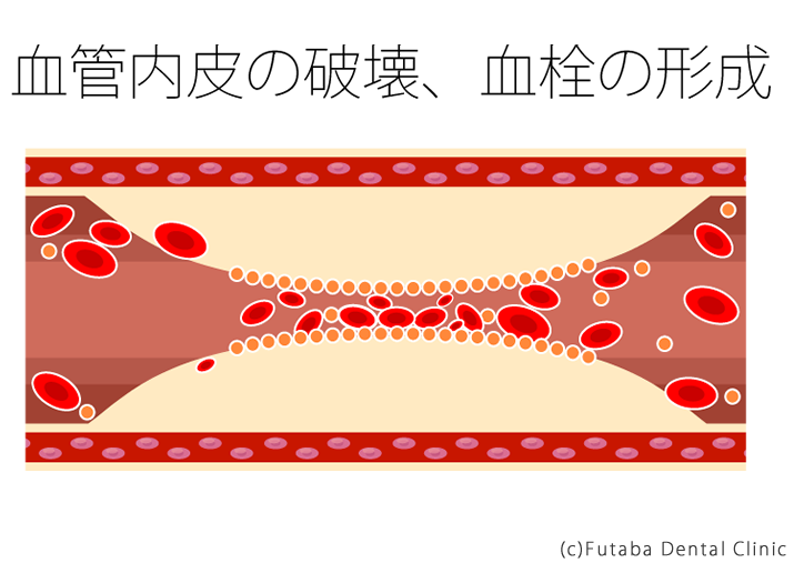 血管内皮の破壊、血栓の形成