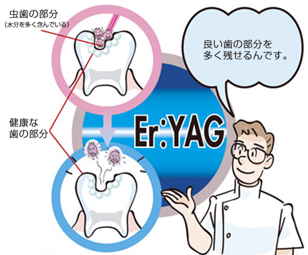 ErYAGレーザー