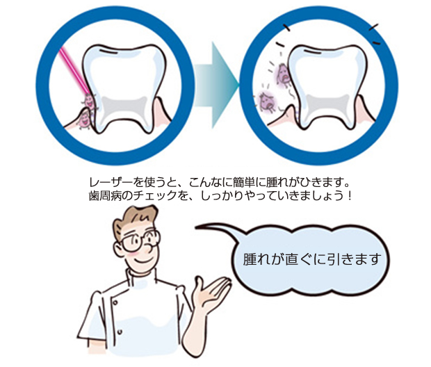 ErYAGレーザー