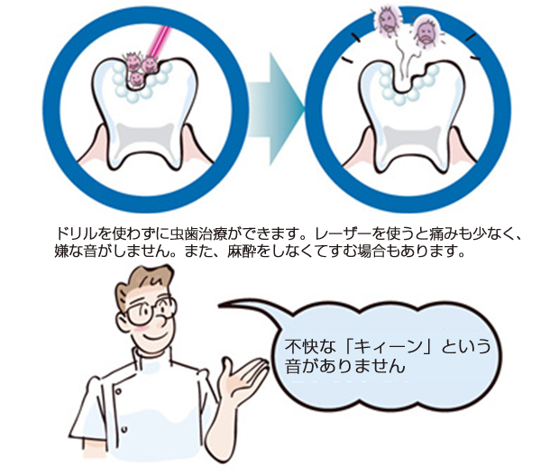 ErYAGレーザー