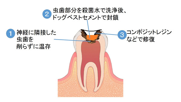 ドックベストセメント治療の流れ