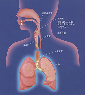 お口の細菌が肺の病気に関係します