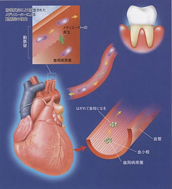 お口の細菌が血管系の病気に関係します