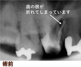 歯牙移植・術前