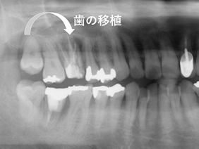 歯牙移植・術後
