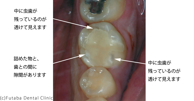 虫歯 治療 後 激痛