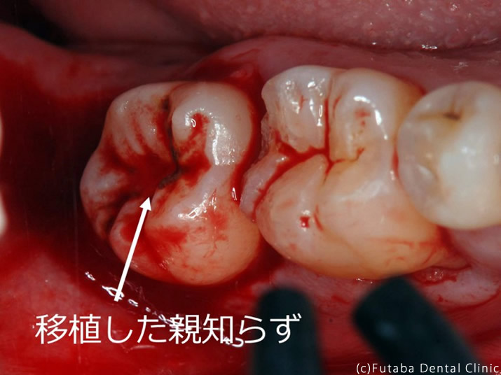 ポスト　口腔内写真