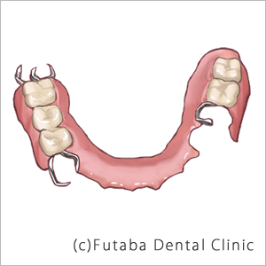 部分義歯