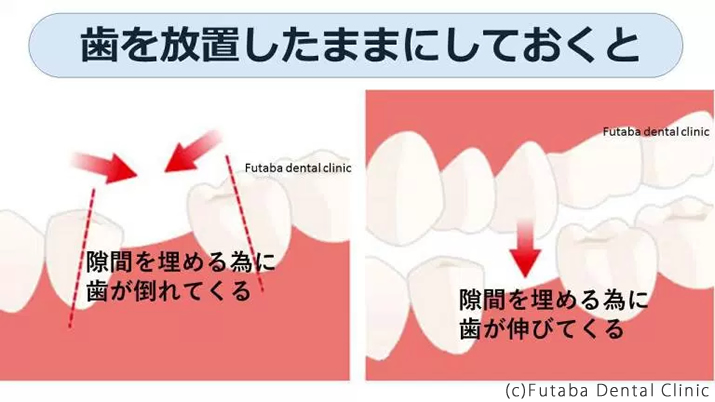 歯を抜いたまま放置