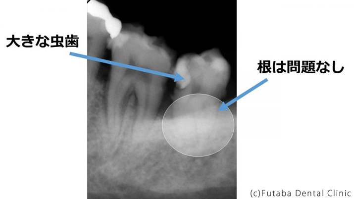 親知らず大きな虫歯