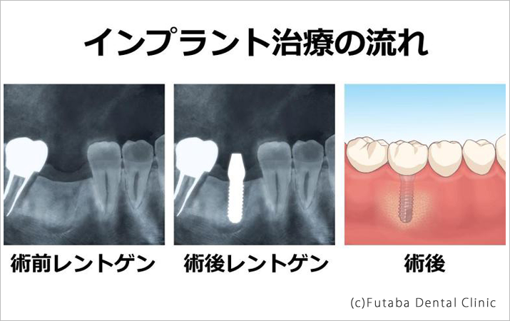 インプラント治療の流れ