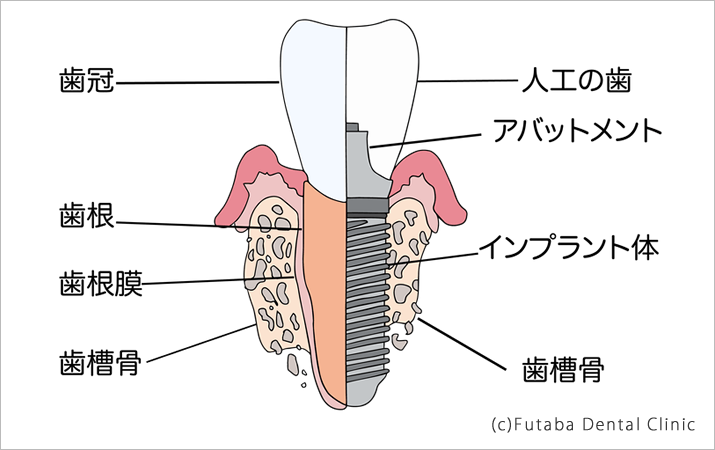 インプラント 歯根膜