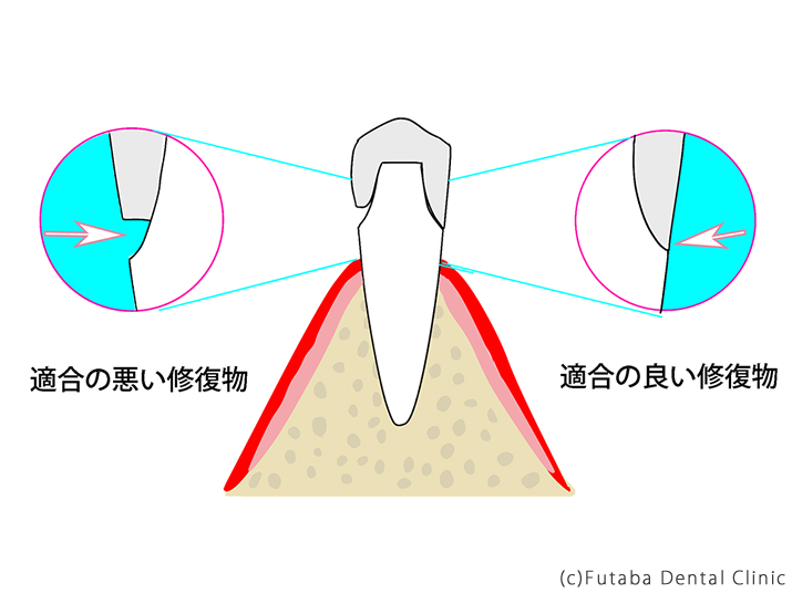 歯型の取り方による違い