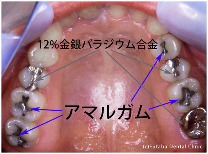 オールセラミッククラウン