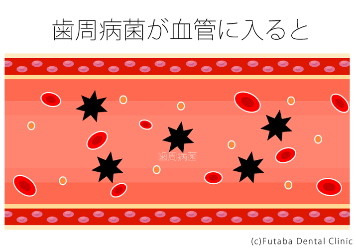 歯周病菌が血管に入ると