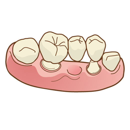 インプラント