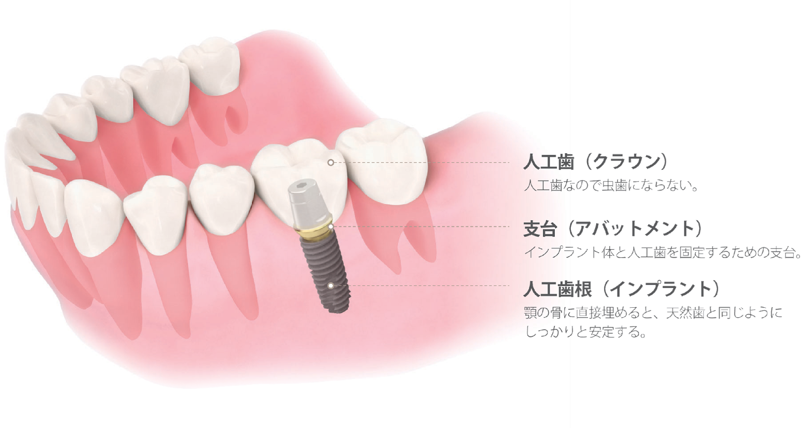 インプラント