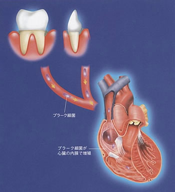 お口の細菌が心臓の病気に関係します