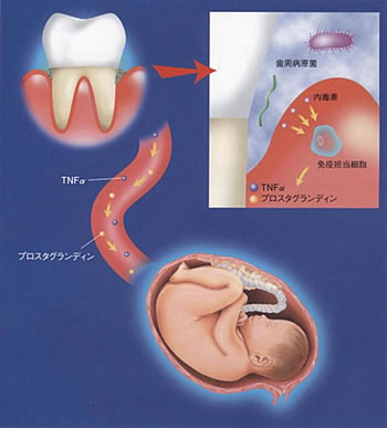 お口の細菌が低体重児出産に関係します