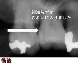 歯牙移植・術後