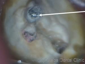 破折リーマ　根管内２