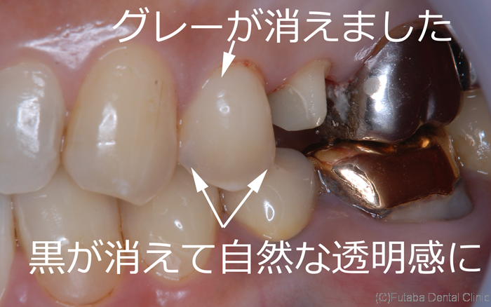 虫歯治療 さいたま市北区 宮原町 日進町 歯医者 雙葉デンタルクリニック