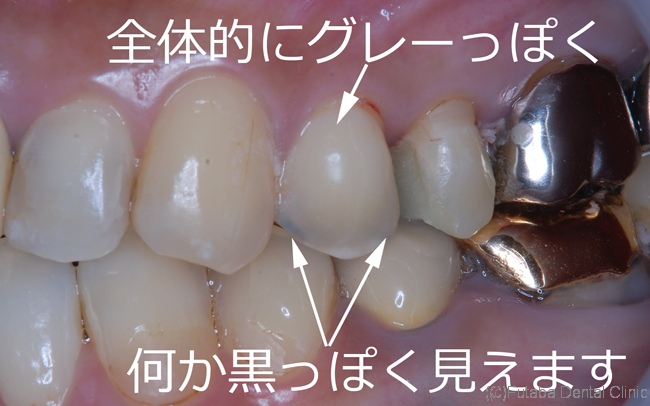 虫歯治療 さいたま市北区 宮原町 日進町 歯医者 雙葉デンタルクリニック