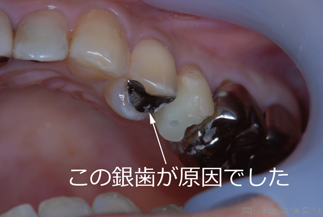 虫歯治療 さいたま市北区 宮原町 日進町 歯医者 雙葉デンタルクリニック