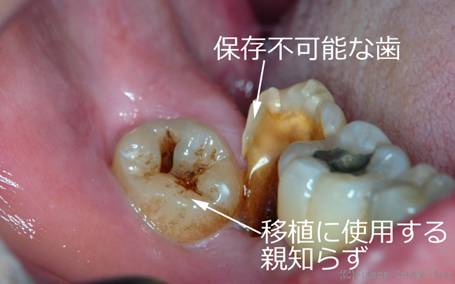 移植口腔内写真１