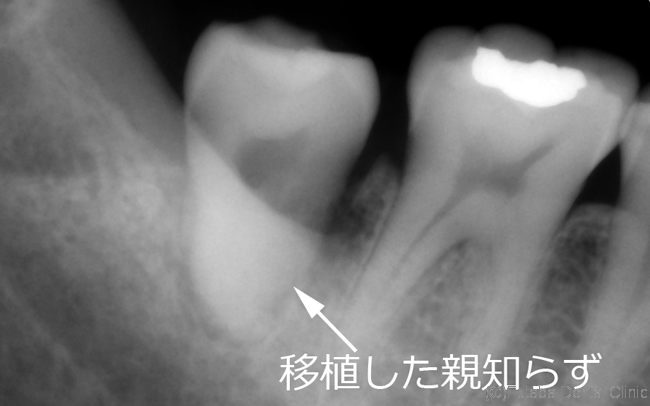 移植後デンタル