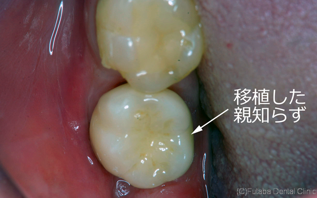 移植後口腔内写真