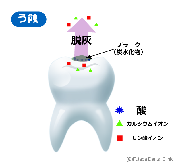 虫歯で歯が溶ける 酸で歯が溶ける さいたま市北区 宮原町 日進町 歯医者 雙葉デンタルクリニック 虫歯で歯が溶ける 酸で歯が溶ける さいたま市北区 宮原町 日進町 歯医者 雙葉デンタルクリニック