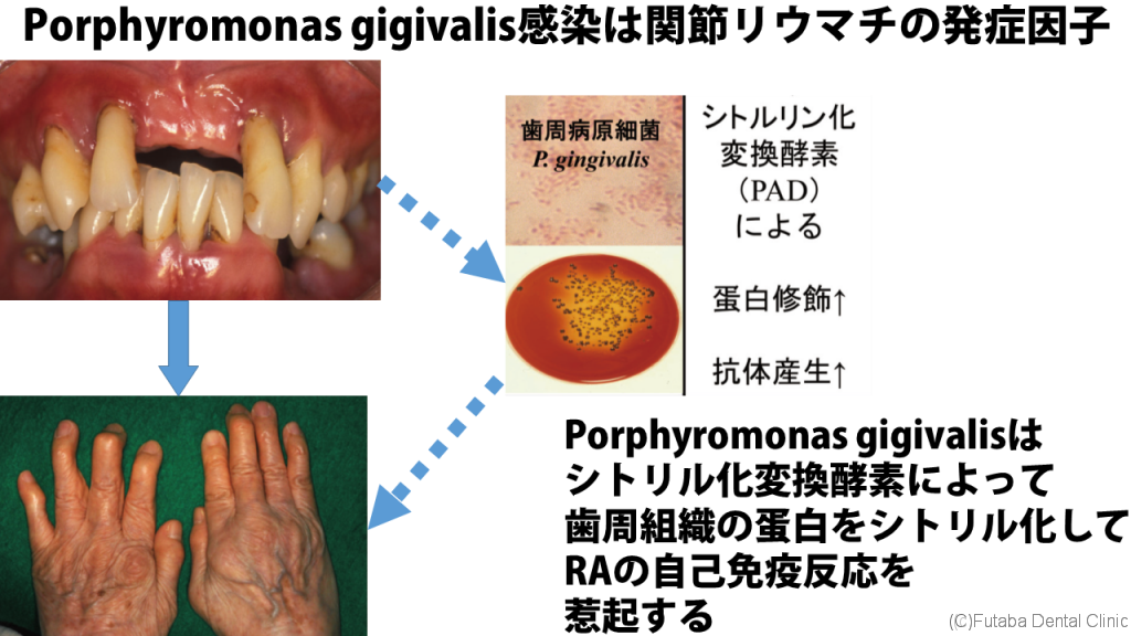 Porphyromonas gingivalis