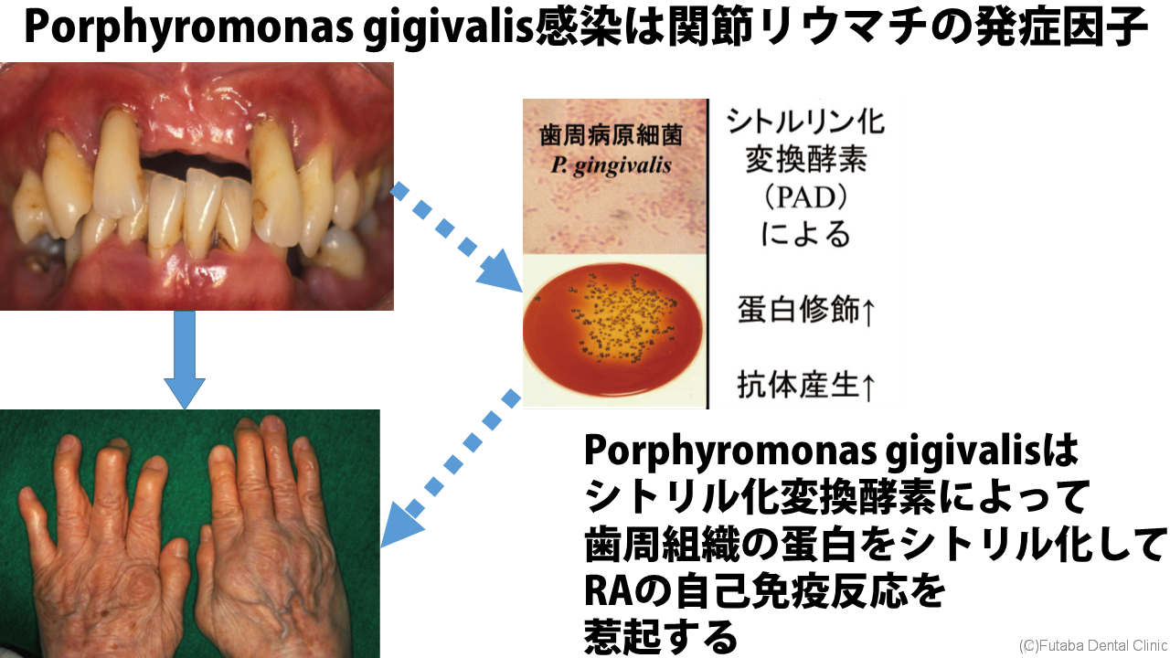 後天性血友病の兆候と症状