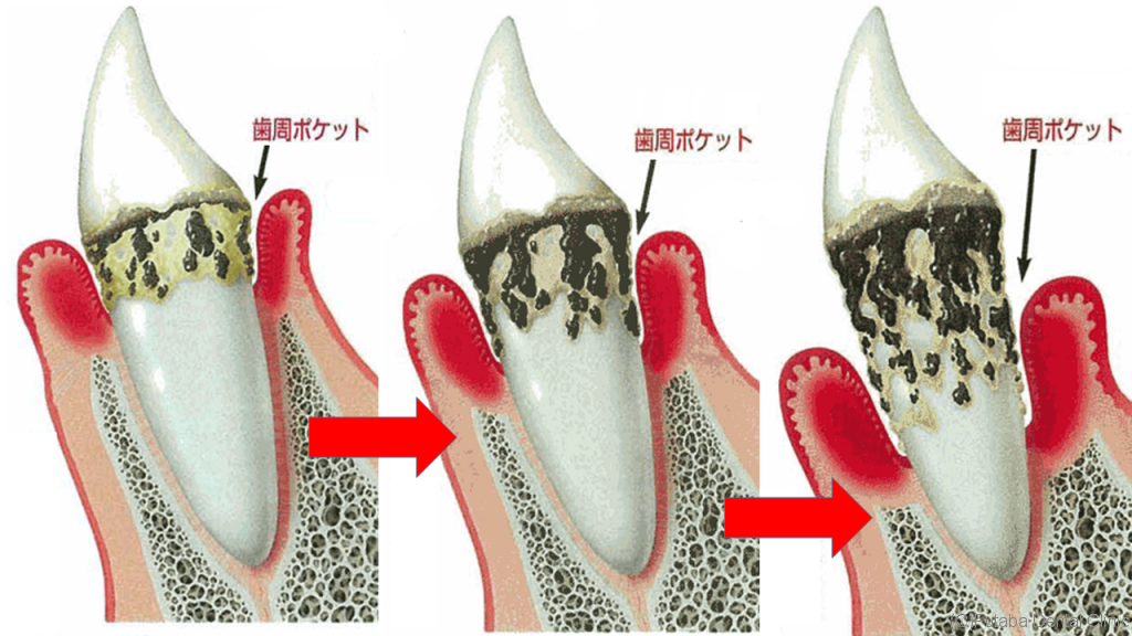 歯周炎の進行