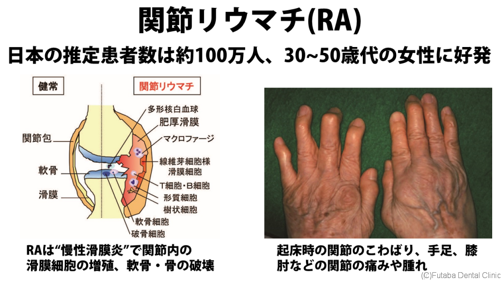 関節リウマチ